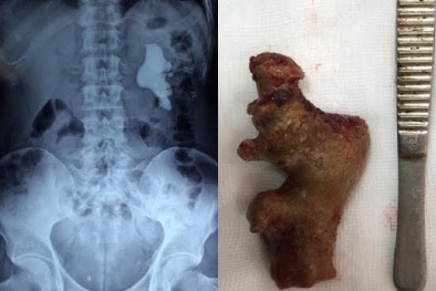 Sỏi thận dài 11cm kích cỡ 'khủng' vì tự ý dùng thuốc nam điều trị