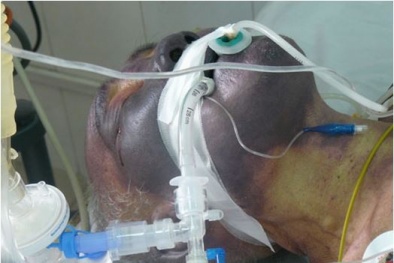 Phú Thọ: Bệnh nhân 67 tuổi tử vong vì ăn tiết canh lợn