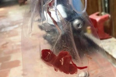 Bệnh nhân bị 'quên gạc' trong chân khả năng cao không bị cắt cụt