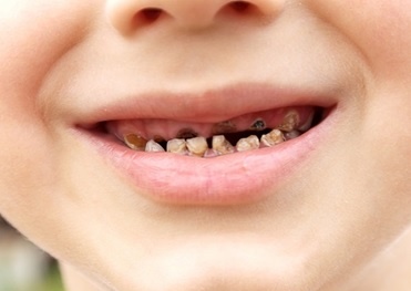 Vạch trần ' sát thủ' phá hủy hàm răng vĩnh viễn