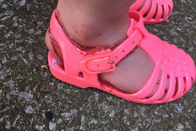 Giật mình chân bé gái 2 tuổi bỗng 'ứa máu' sau khi đi đôi dép xăng đan 30 phút 