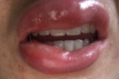 Hết hồn với khuôn mặt biến dị vì mê sử dụng sản phẩm làm trắng răng