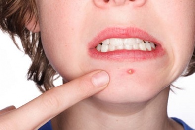 Những cách trị mụn 'sai bét' khiến ung thư da phát triển mạnh 