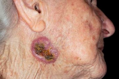 'Sát thủ' gây ung thư da bủa vây người Việt