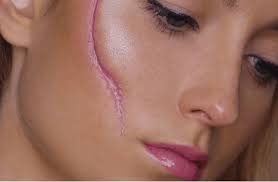 Cảnh giác vết sẹo có thể mang ung thư da tới 