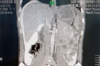 Suýt mất mạng vì vỡ bàng quang mà không biết