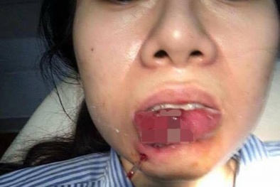 Cắt bỏ 1/3 môi sau khi tiêm chất làm đầy