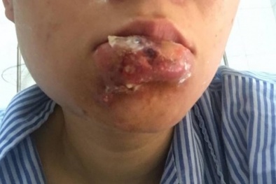 Tiêm chất làm căng mọng, nguy cơ mất mạng, mù mắt cao