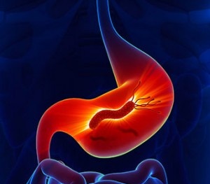 Hơn 70% người Việt Nam nhiễm vi khuẩn HP