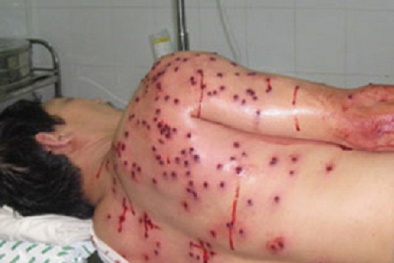 2 thanh niên bị nhóm người lạ mặt đi ô tô bắn bằng súng hoa cải