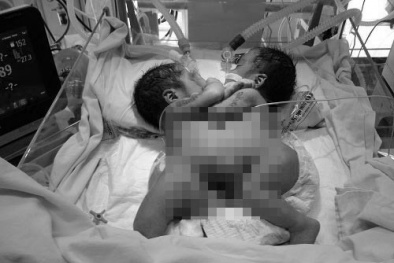 2 bé song sinh dính liền tổn thương tim phức tạp đã ra đi mãi mãi