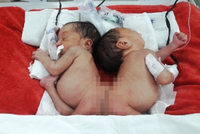 3 tháng nữa sẽ mổ tách 2 bé gái S’tiêng dính nhau phần mông