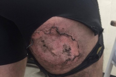 Tín đồ Apple suýt mất đùi phải vì iPhone 6 phát nổ trong túi quần