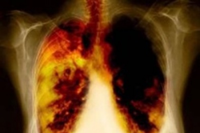 Ung thư phổi tăng cao do ô nhiễm không khí
