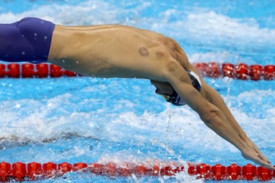 Khi kình ngư Michael Phelps cũng nhờ cậy… giác hơi