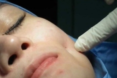 Mặt biến dạng vì phẫu thuật má lúm đồng tiền