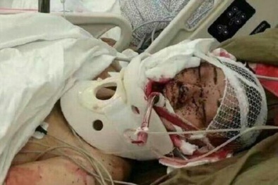 Cận cảnh gương mặt biến dạng của người phụ nữ bị hổ tấn công trong công viên