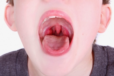 Cách chữa viêm họng cấp tốc không cần đến thuốc