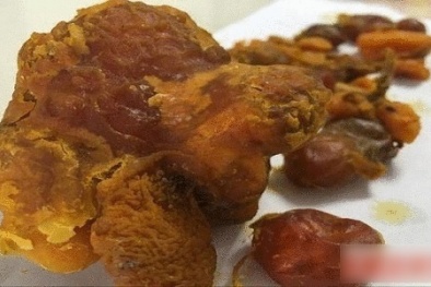 Dị vật nghi là 'kê bảo' trong bụng gà có thể trị giá hàng trăm nghìn USD