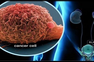 Cảnh báo: Những loại thực phẩm càng ăn càng “vỗ béo” tế bào ung thư