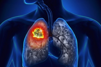Những con số đáng báo động về ung thư phổi tại Việt Nam 
