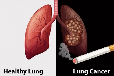 Chỉ 'hít' khói cũng ung thư phổi