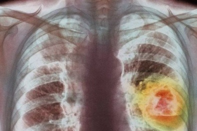 Bác sĩ nói về thủ phạm gây bệnh ung thư phổi mà ca sĩ Minh Thuận mắc phải