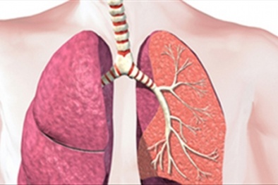 Căn bệnh ở phổi tưởng bình thường nhưng dễ tử vong hơn ung thư 