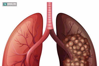 Ung thư phổi: Căn bệnh gây tử vong hàng đầu