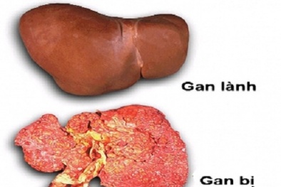 Cảnh báo tác hại của bia rượu 'hung thần' gây các bệnh về gan