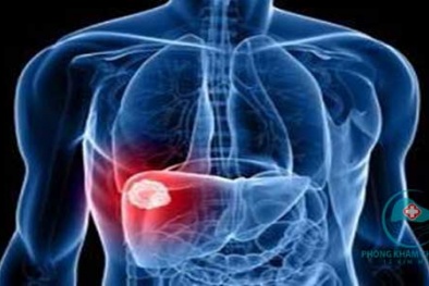 Ung thư gan: Bệnh nguy hiểm mà khó phát hiện