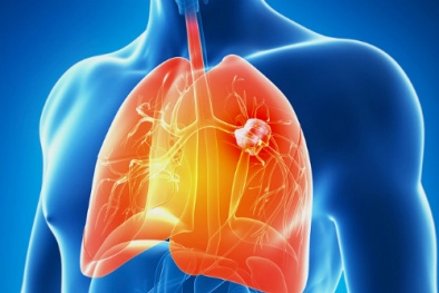 10 'thủ phạm' không ngờ tới vẫn hiện hữu trong nhà gây ung thư phổi