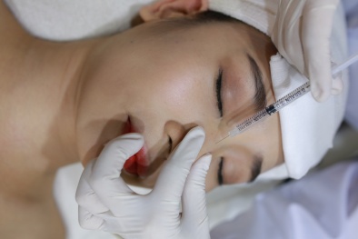 Mũi bị hoại tử, biến dạng vì nâng mũi thẩm mỹ bằng chỉ