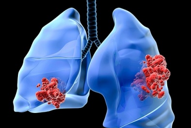Ngoài thuốc lá, đây cũng là thủ phạm gây ung thư phổi 