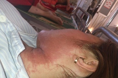 Nổi mụn, rỉ nước vàng khắp đầu vì thuốc nhuộm tóc