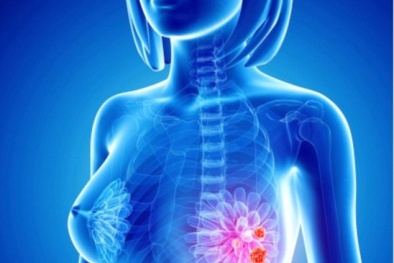 Ung thư vú: Các triệu chứng mà chị em thường bỏ qua