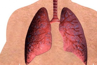 Hút thuốc lâu năm cũng sẽ giảm nguy cơ ung thư phổi nếu bổ sung chất này
