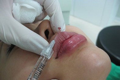 Kinh hãi dịch vụ làm đẹp bơm môi trái tim thành... môi hoại tử