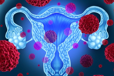 Ung thư buồng trứng: 'Sát  thủ thầm lặng' của phụ nữ