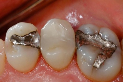 Nguy cơ nhiễm thủy ngân do hàn răng