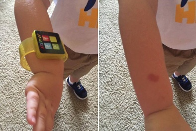 Da phồng rộp vì đồng hồ thông minh