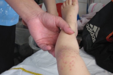 Bệnh tay chân miệng: Bộ Y tế khuyến cáo cách phòng chống
