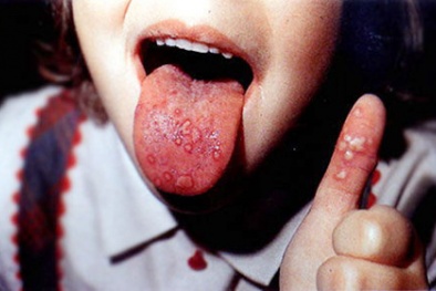 Giữa ‘mùa’ bệnh chân tay miệng, Bộ Y tế khuyến cáo cách phòng chống