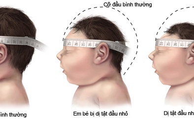 Thêm 2 trẻ bị dị tật đầu nhỏ nghi do nhiễm Zika tại Đắk Lắk