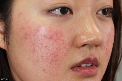 Cần hỏi kỹ tiền sử dị ứng thuốc của bệnh nhân trước khi kê đơn