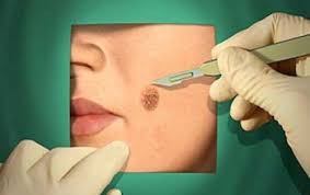 Tin cảnh báo nổi bật ngày 24/10: Coi chừng rước họa vì xăm, tẩy nốt ruồi