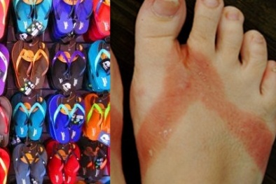 7 nguy cơ gây hại sức khỏe từ dép tông