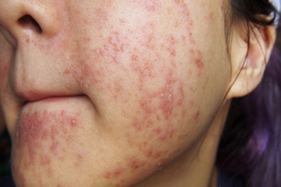 Làm gì khi bị dị ứng mỹ phẩm