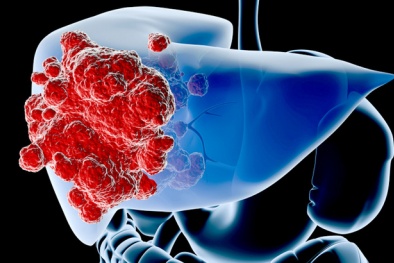 Ung thư gan: Lộ mặt thủ phạm ẩn nấp trong hàng ngàn người Việt