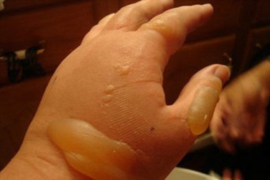 Trẻ nhỏ bị bỏng nước sôi: Lời cảnh tỉnh cho cha mẹ khi mùa Đông đến